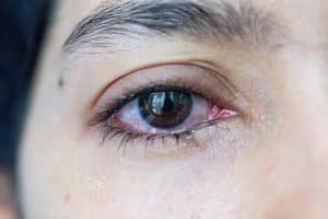 Close-up of a red, irritated, and watery eye with dry skin around it.